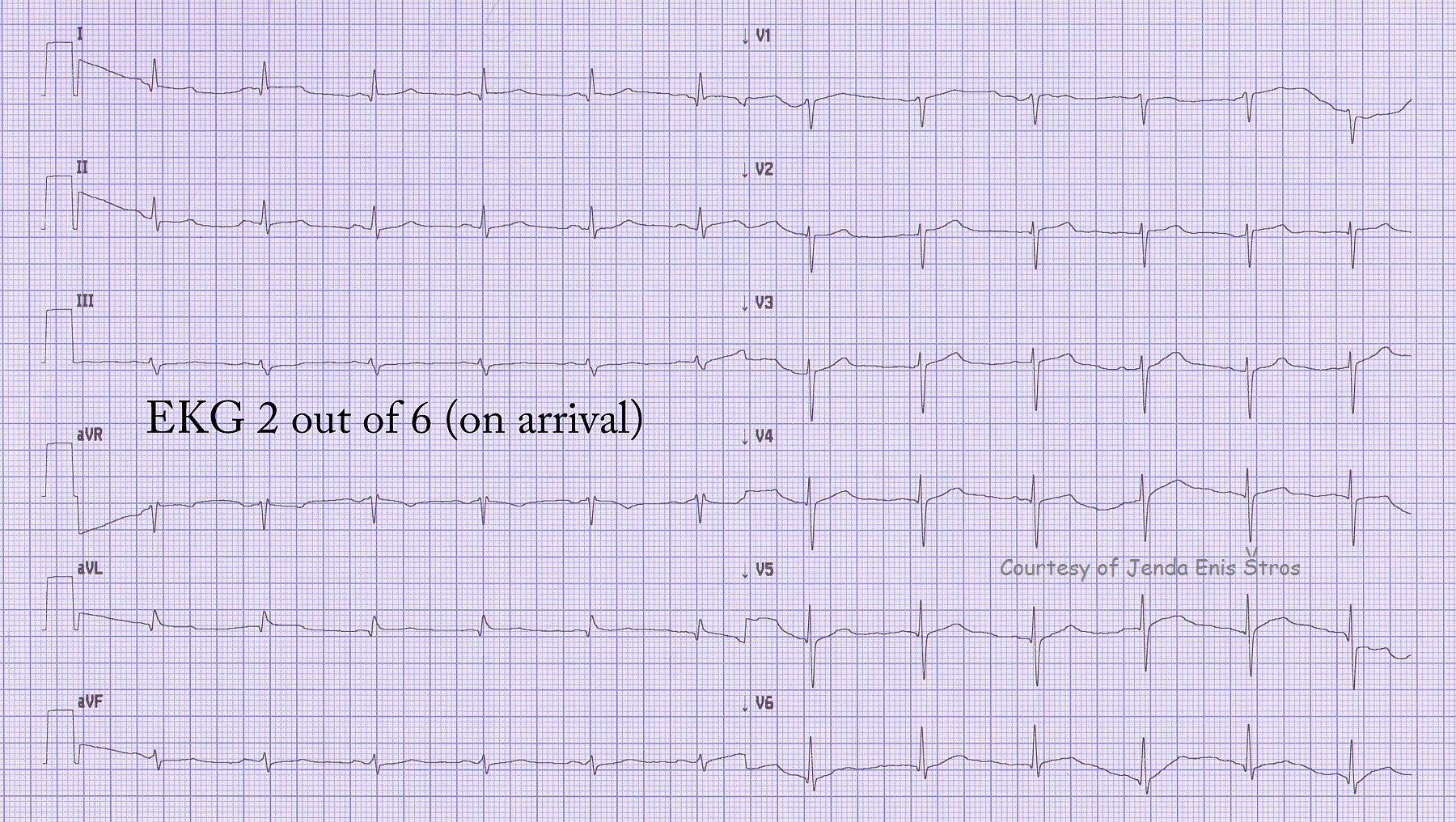 Anterior wall M.I. | Page 2 | ECG Guru - Instructor Resources